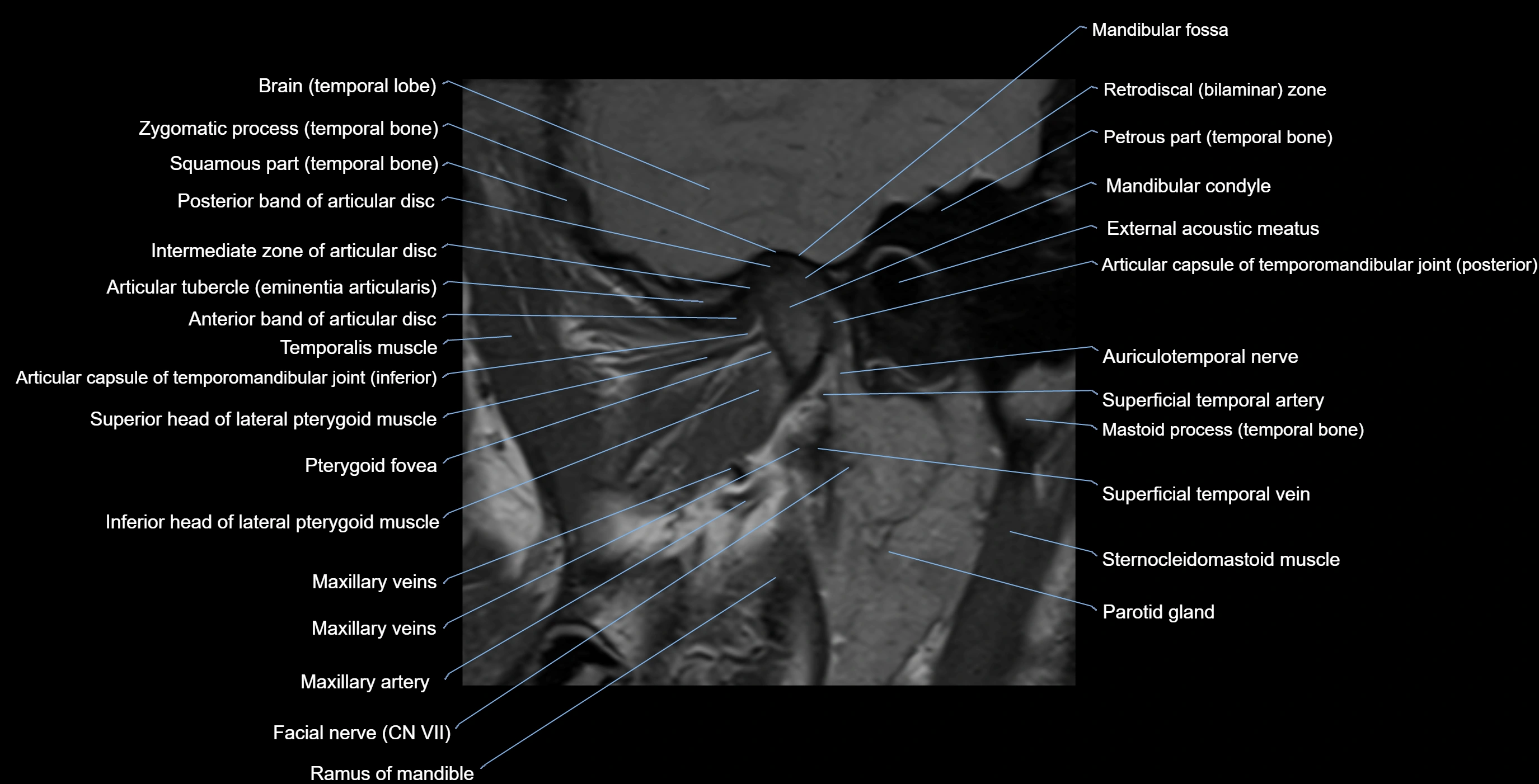 MRI TMJ sagittalclosed  mouth cross sectional 3T anatomy -img-00001-00009.webp